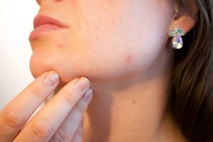 Help For Dry Skin With Blackheads By Beauty Salon Hobbiton – Call Us On 07 888 9960